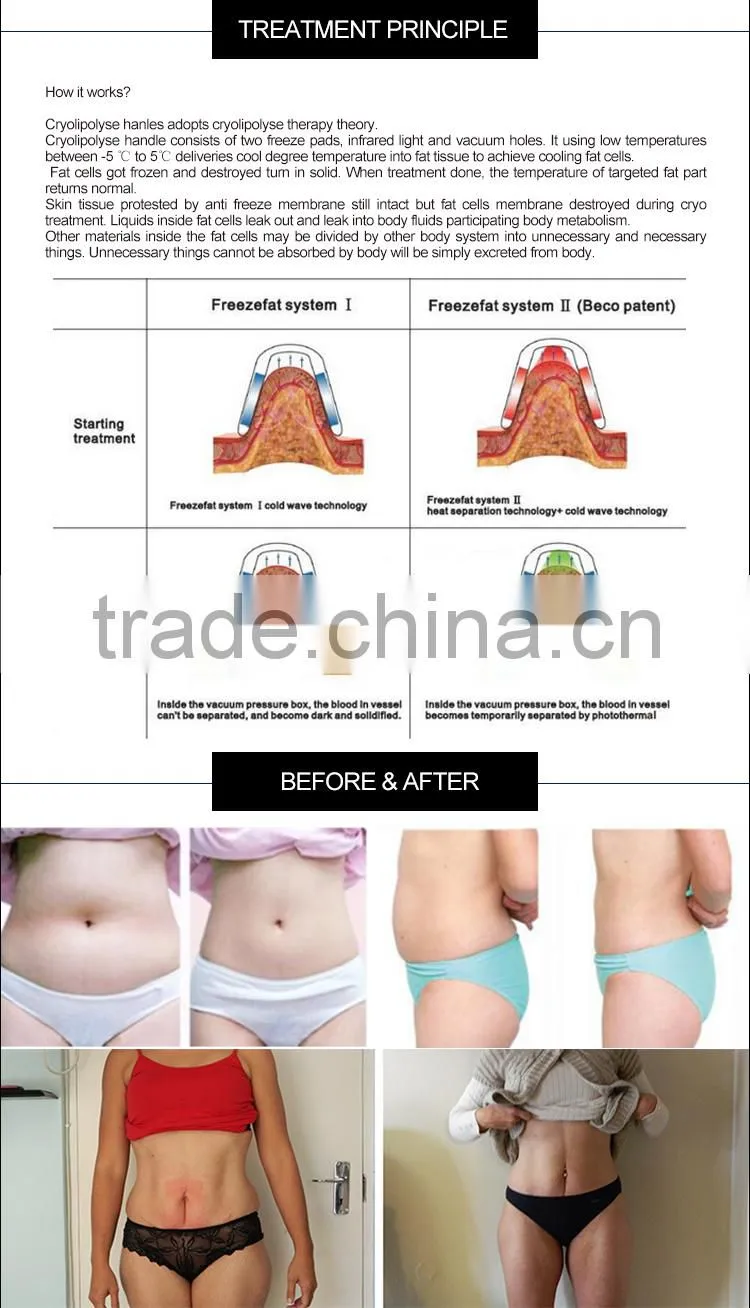Fat Freezing&Body slimming machine with 2 handles at the same time work