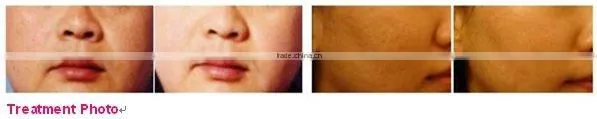 Super pulse CO2 medical laser skin resurfacing beauty