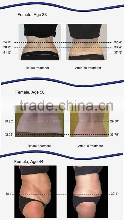 2014 Professional semiconductor laser treatment instrument cavitation fat burning instrument