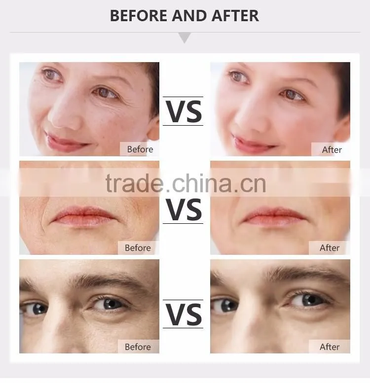 rf cavitation machine for smoother and tighter skin texture