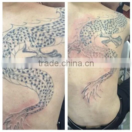 Portable Q-Swith ND YAG laser tattoo removal /tattoo removal/skin rejuvenation ,vascular removal ,spot age for beauty salon