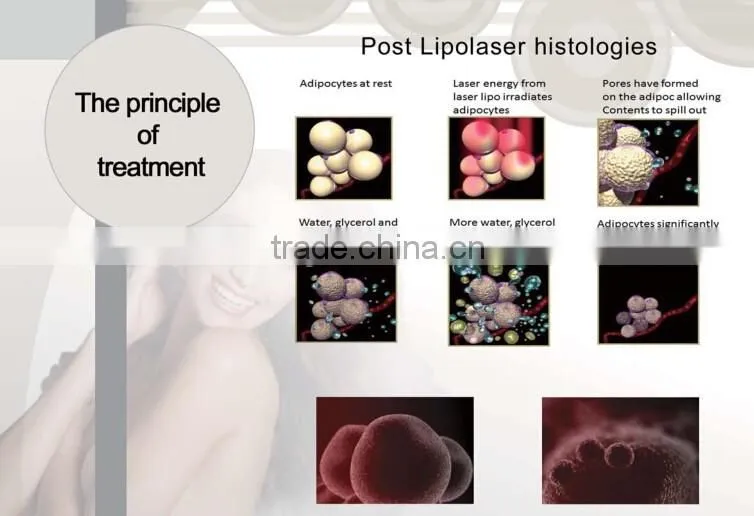 Lipolaser slimming machine loss weight and cavitation machine