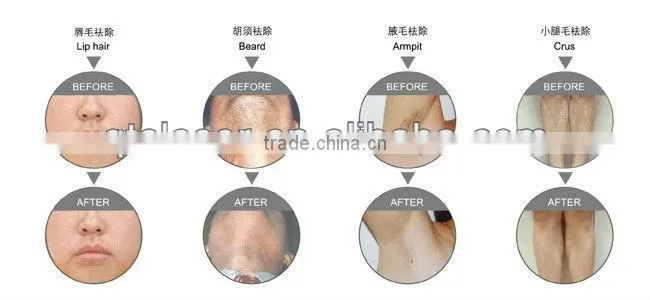 DIscounted price long pulse laser machine with ND-YAG for hair and toenail fungus treat