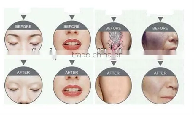 VY-LS450 Q switch laser tattoo removal machine price