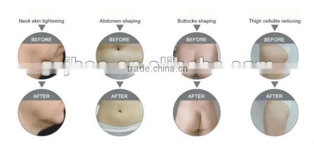 hot supersonic liposuction sliming machine