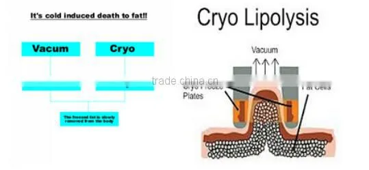 cryolipolysis fat reducing machine/cryolipolysis fat removal machine/ cryolipolysis machine