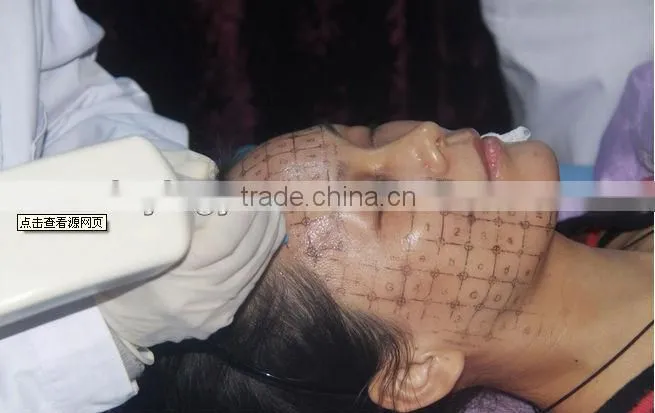 Hotsale thermagic rf for wrinkle removal