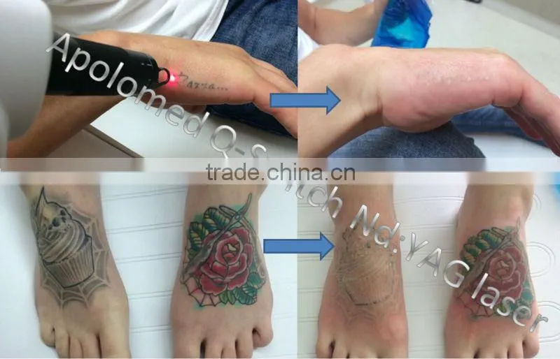 Tattoo studio favourite Q Switched ND YAG laser tattoo removal system