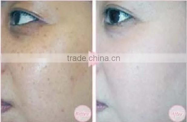 2017 Newest meso injection gun korea for hyaluronic acid gel injection / mesotherapy gun with CE Certificate