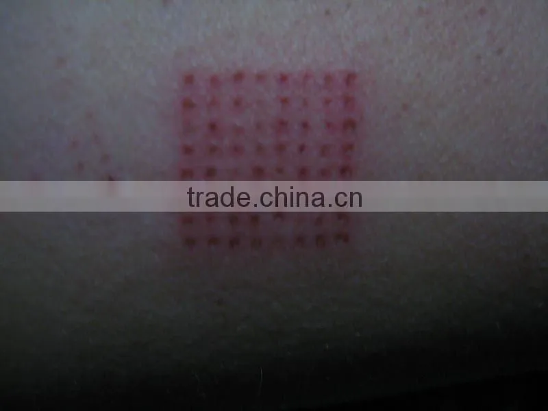 CO2 fractional scar removal laser