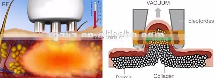 wholesale price ultrasound physiotherapy/cavitation slimming machine