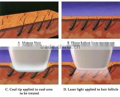 hair removal dubai