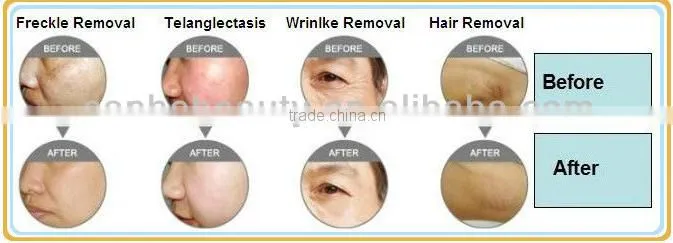 CE Dual system E-light IPL SHR hair removal machine/ Elight SHR/ shr laser
