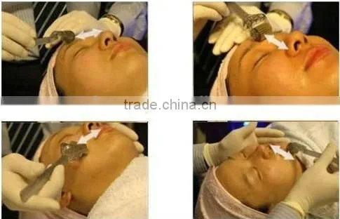 Chinese Micro Needling treatment skin needling for cosmetic