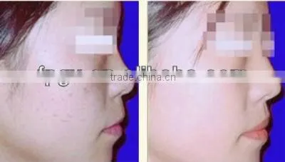Professional Skin Rejuvenation and Hair Removal IPL Beauty Equiment