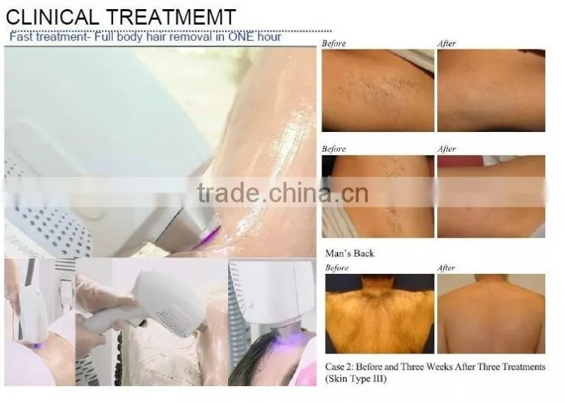 Germany Bars professional laser hair removal machine