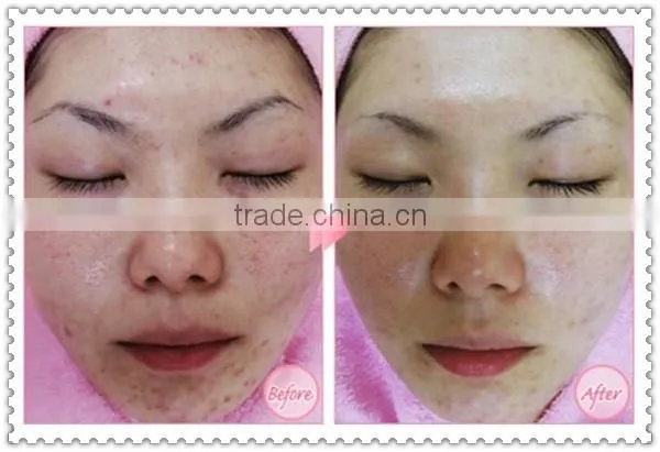 Professional 5 in 1 microdermabrasion machine