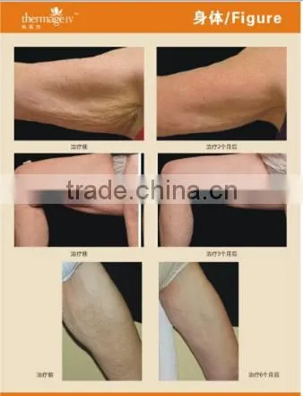 AYJ-C19(CE) Dot matrix portable thermal rf beauty equipment fractionel