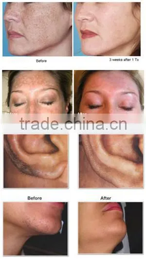 professional American crystal IPL painless hair removal Machine