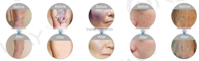 Beauty Salon / Spa use! Most Professionally 3 probes 1064&532&1320nm yag laser tattoo removal system equipment