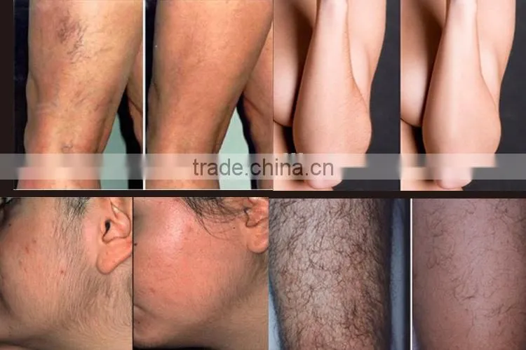 FDA technology newest most advanced painfree efficient professional IPL laser hair removal machines for sale