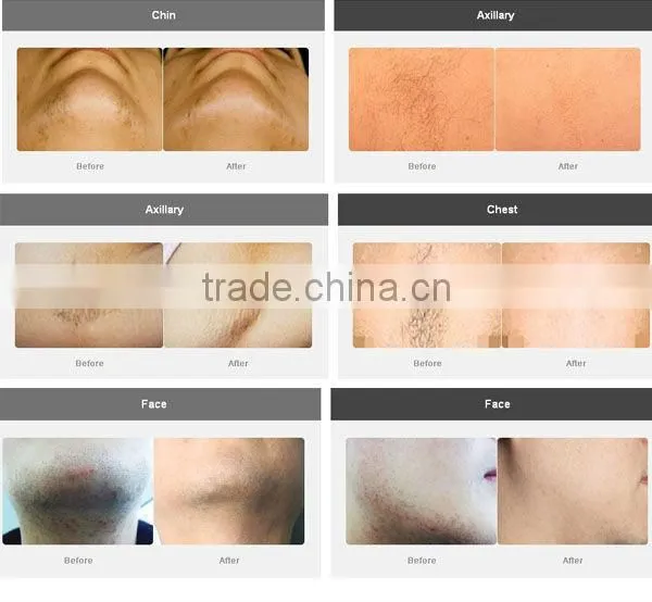 2016 IPL Beauty Home Use Diode Laser Hair Removal Machine