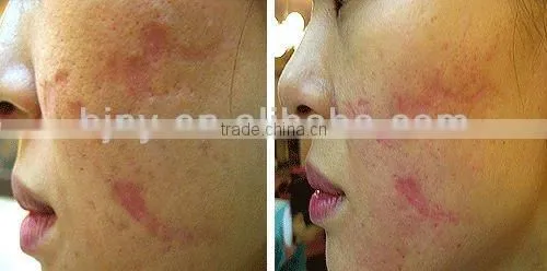 MNS derma roller microneedle derma roller mesotherapy derma roller