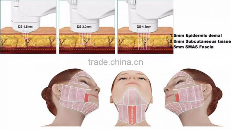 Vaginal HIFU Machine/Skin Tightening Machine/ Portable HIFU Machine