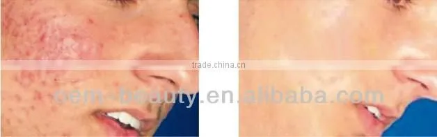 Medical CE IPL hair removal machine pigment acne treatment