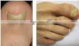 Big price cut ND yag laser equipment hair removal treatment