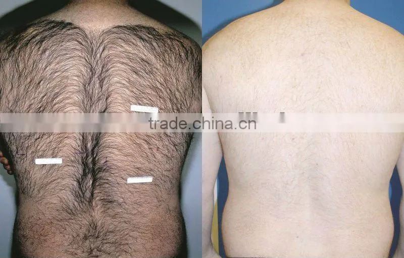 1064 laser permanently Hair remover for women P003