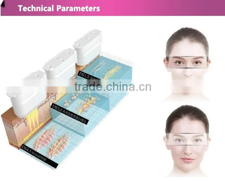 hifu/high intensity focused ultrasound/hifu machine