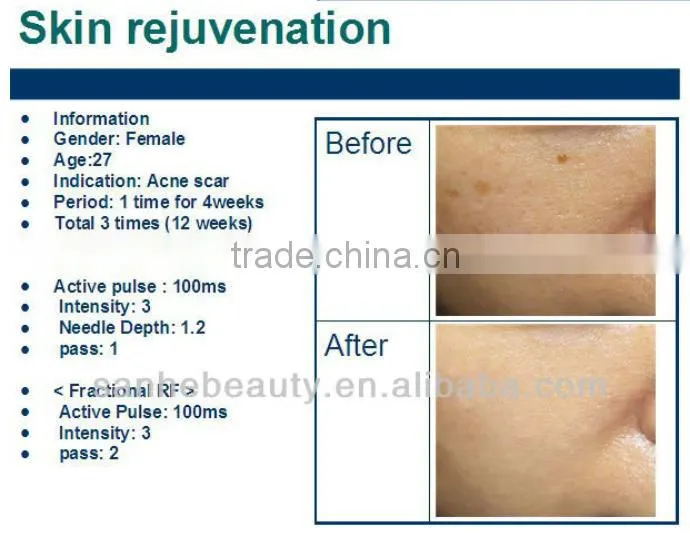 advanced technology face lift fractional microneedle rf machine