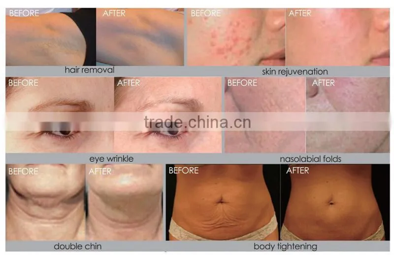 RF and lipo laser machine for fat removal face lifting lipo cold laser fda machine