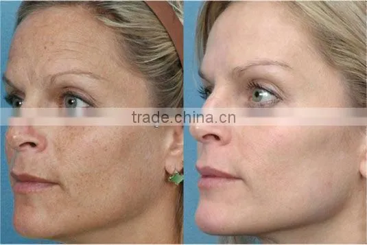 Elight IPL RF Acne Treatment--C005