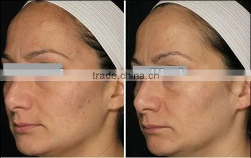 G006 OEM pdt/led therapy skin tightening device home use