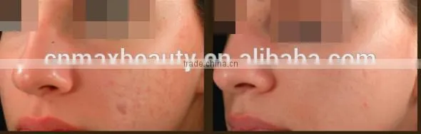 M-D3 best selling hot chinese products professional microdermabrasion machine