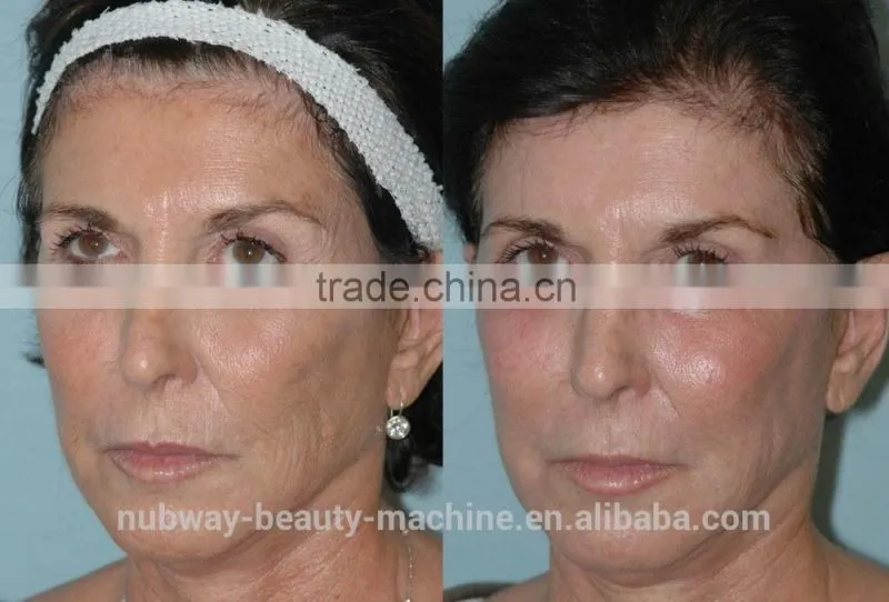 Effectively Best Quality Professional Clinic Use Fractional CO2 Laser Acne Scar Removal