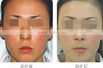 Top sale Beauty machine elight IPL RF for hair removal and skin care