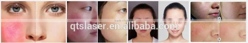 2016 new 980nm diode laser for vascular removal blood vessels removal/anti-redness remover/skin care