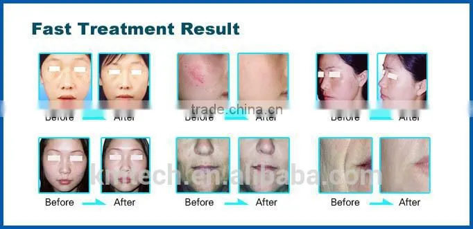 2016 elight ipl rf nd yag laser tattoo removal/skin rejuvenation machine