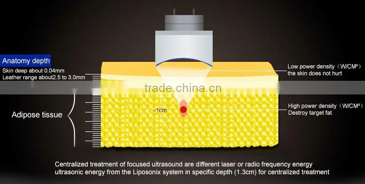 Brighter shopping best HIFU slimming High Intensity Ultrashape liposonix slimming with FDA