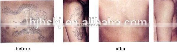 2015 new pianess safe tattoo removal & vascular treatment