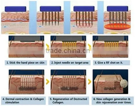 Portable lattice rf microneedle fractional rf wrinkles removal equipment