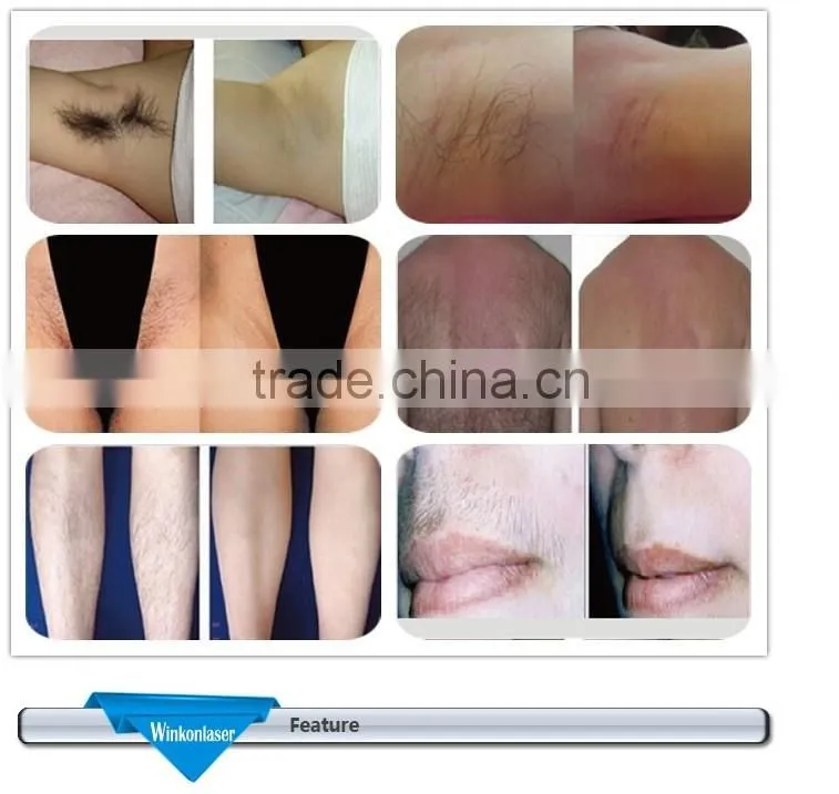 diode laser hair removal portable