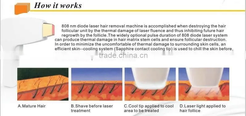 Germany Laser Module 808nm diode laser hair removal machine