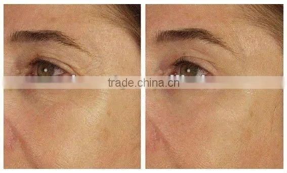 RF Machine For Facial Treatment B026(Instant effects)