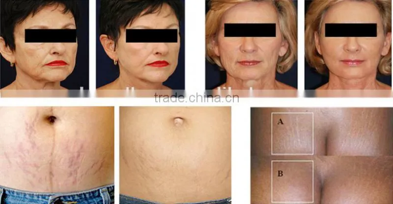 oxygen jet skin care beauty equipment dermabrasion