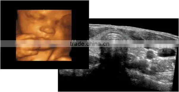 4d ultrasound handheld, 4d ultrasound machine portable 3d 4d ultrasound