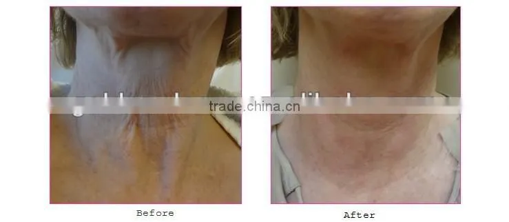 2014 New Style Face and neck tightening and firming Viora Reaction Machine